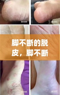 腳不斷的脫皮，腳不斷脫皮還癢 