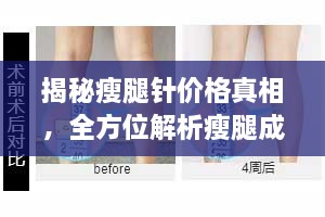 揭秘瘦腿針價格真相，全方位解析瘦腿成本！