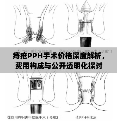 痔瘡PPH手術(shù)價(jià)格深度解析，費(fèi)用構(gòu)成與公開透明化探討