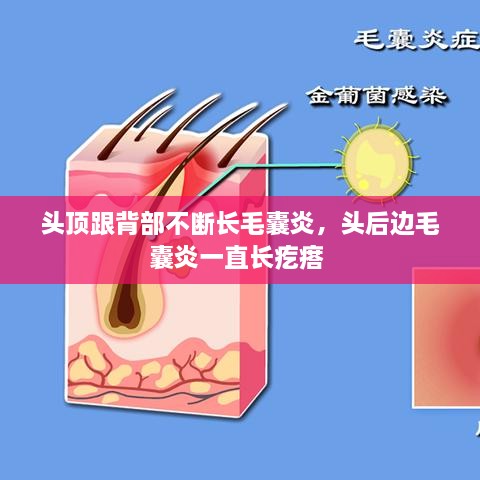 頭頂跟背部不斷長(zhǎng)毛囊炎，頭后邊毛囊炎一直長(zhǎng)疙瘩 