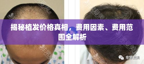 揭秘植發(fā)價(jià)格真相，費(fèi)用因素、費(fèi)用范圍全解析