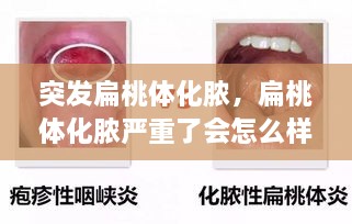 突發(fā)扁桃體化膿，扁桃體化膿嚴重了會怎么樣了 