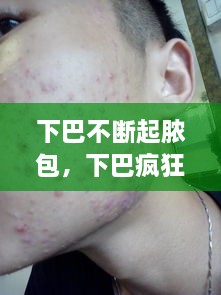 下巴不斷起膿包，下巴瘋狂長(zhǎng)膿包 