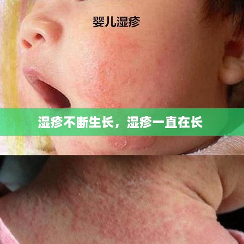 濕疹不斷生長，濕疹一直在長 